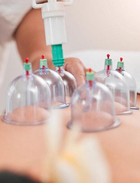 Hijama Cupping Therapy
